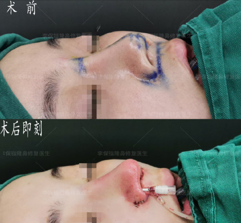 杭州鼻综合修复手术哪个医生好？