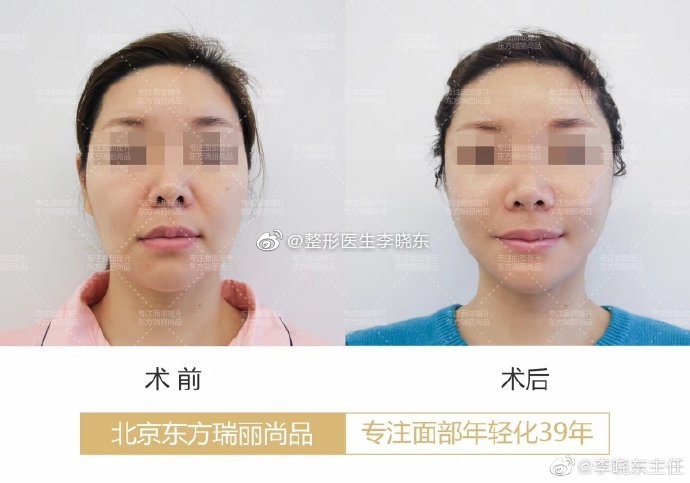 李晓东面部提升案例