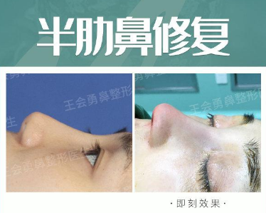 上海技术最好的鼻修复专家是谁？