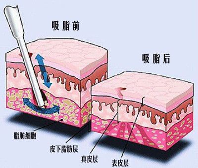 成都面部抽脂哪个医生好？成都吸脂专家预约前十名