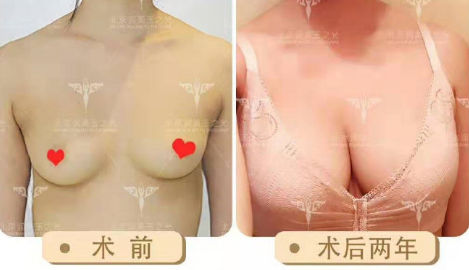 北京自体脂肪隆胸最好的医生有哪些？