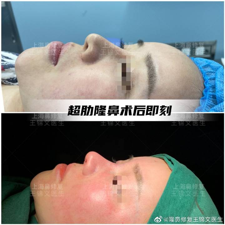 王锦文做鼻子案例
