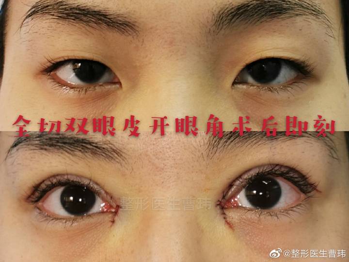 曹玮割双眼皮案例