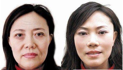 上海九院做面部提升哪个做得好？