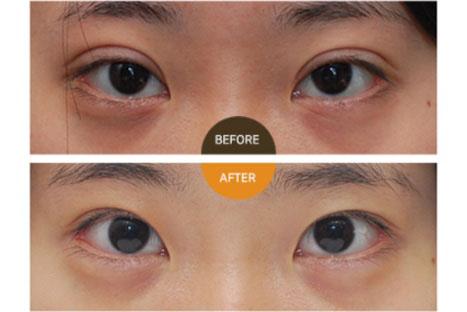 北京双眼皮修复比较好的医生有哪些？眼修复专家前十名排名