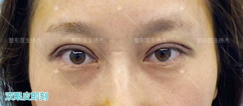 武汉协和杨杰割双眼皮技术好吗？