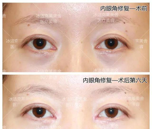 北京修复眼角厉害的医生是谁？